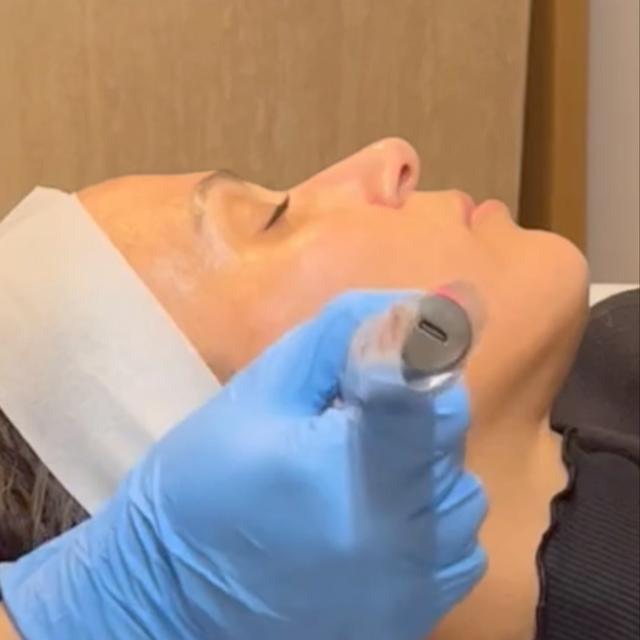 Microneedling- 3 Treatments 